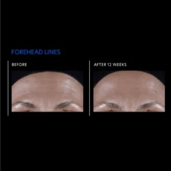 PCA Skin ExLinea Pro 15 PCA Skin ExLinea Pro -Cosmetics Store Exlinearesults4 1500x1500 6d80c8fc 9714 467d 94ae 40dd80eb4ee6