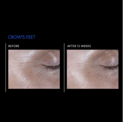 PCA Skin ExLinea Pro 16 PCA Skin ExLinea Pro -Cosmetics Store Exlinearesults5 1500x1500 01178537 ddc0 43bc acf6 97b488dc5155